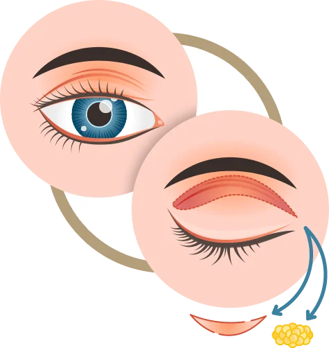 Ícone Pálpebra Superior